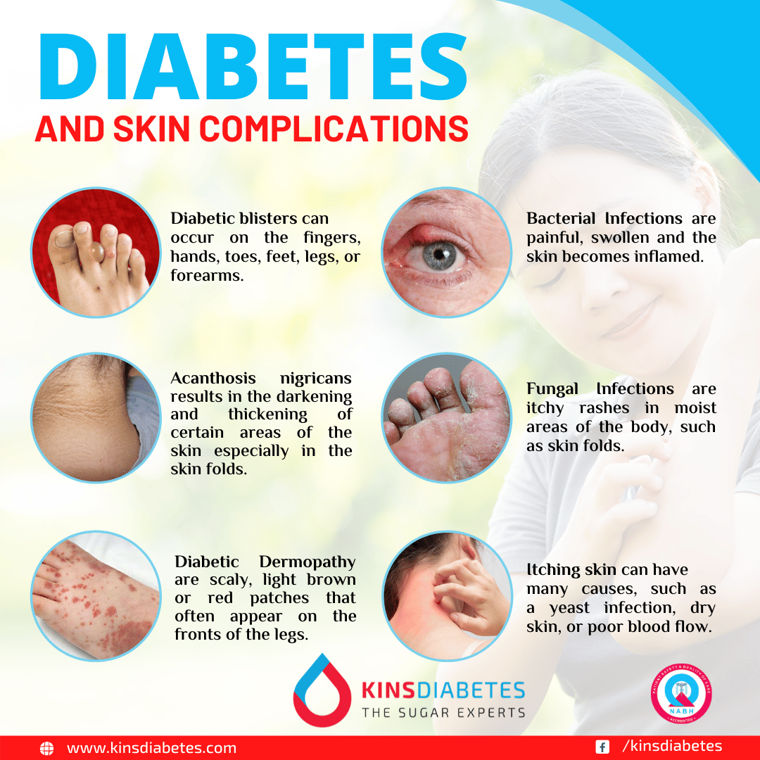 Can High Blood Sugar Cause Skin Itching